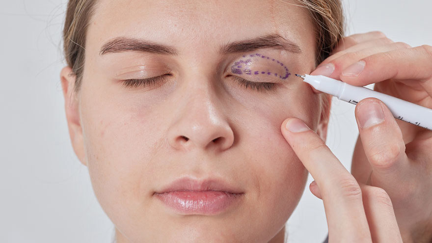 Revisional Eyelid Surgery